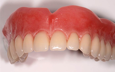 full-dentures-01