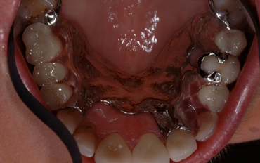 partial-dentures-sidebar-2