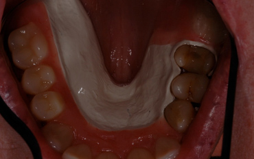 partial-dentures-sidebar-3