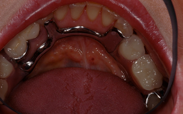 Partial Dentures